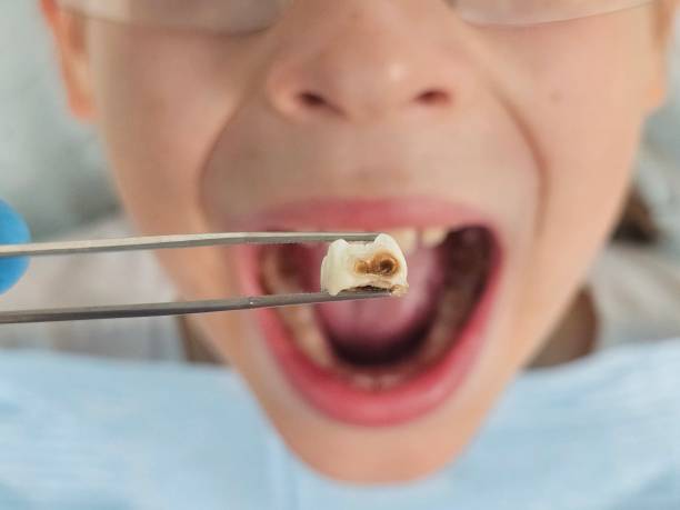 Best Urgent Care for Lost Fillings or Crowns in Richland, WA